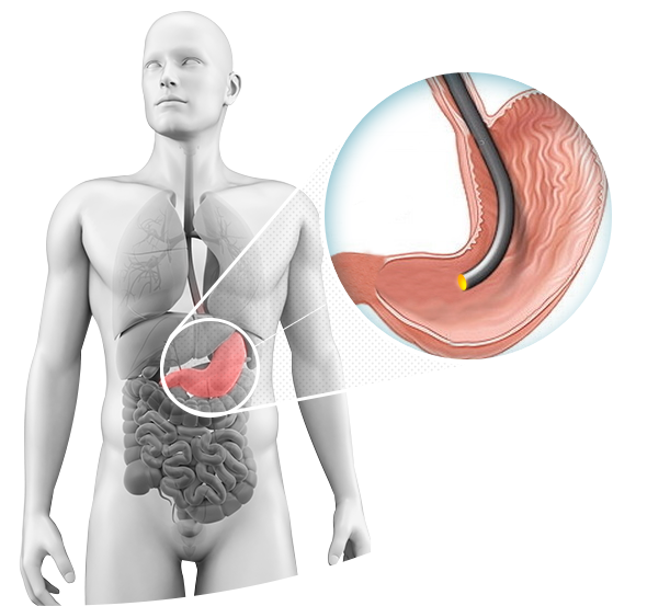 
								<h1>
									<span>
										ENDOSCOPIA 
									</span>
								</h1>
								<p>
									Olhar para dentro do paciente. É isso que a Endoscopia Digestiva realiza. É uma especialidade médica que permite o diagnóstico e tratamento de doenças do aparelho digestivo.
								</p>    
								<a href="https://www.clinicazago.com.br/exames/endoscopia/">Saiba mais</a> 
							