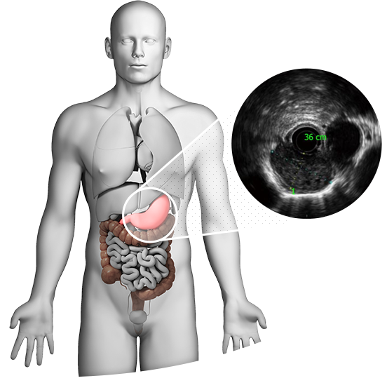 
								<h1>
									<span>
										ECOENDOSCOPIA 
									</span>
								</h1>
								<p>
									Na Clínica Zago, realizamos os exames de Ecoendoscopia, também conhecida como ultrassonografia endoscópica, método inovador que associa a endoscopia digestiva com a ultrassonografia em um mesmo procedimento.
								</p>    
								<a href="https://www.clinicazago.com.br/exames/">Saiba mais</a> 
							