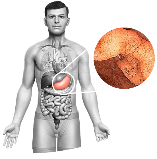 
								<h1>
									<span>
										DISSECÇÃO SUBMUCOSA 
									</span>
								</h1>
								<p>
                                A técnica de dissecção endoscópica da submucosa, também conhecida como ESD , foi introduzida e se tornou a técnica de escolha para a remoção de alguns tipos de tumores do esôfago, estômago e intestino.
								</p>    
								<a href="https://www.clinicazago.com.br/procedimentos-terapeuticos/disseccao-endoscopica-submucosa/">Saiba mais</a> 
							