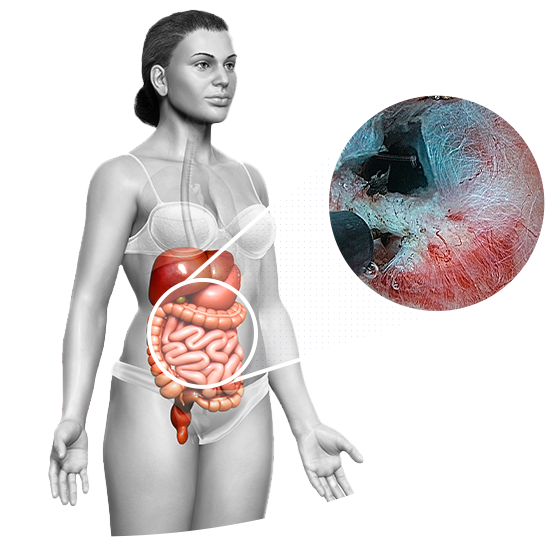 
								<h1>
									<span>
										POEM
									</span>
								</h1>
								<p>
                                Há aproximadamente 10 anos, foi introduzida uma nova técnica de tratamento por endoscopia, uma cirurgia minimamente invasiva, chamada Miotomia Endoscópica Peroral (POEM - Peroral Endoscopic Myotomy). 
								</p>    
								<a href="https://www.clinicazago.com.br/procedimentos-terapeuticos/poem-miotomia-endoscopica-peroral/">Saiba mais</a> 
							