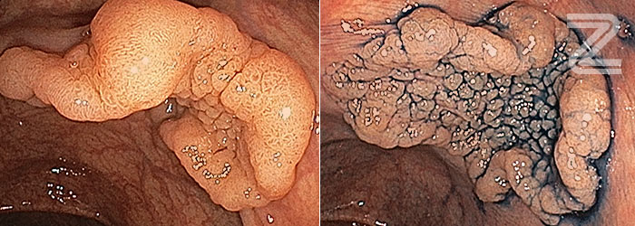 Dissecção Endoscópica da Submucosa (ESD) – Cirurgia Endoscópica